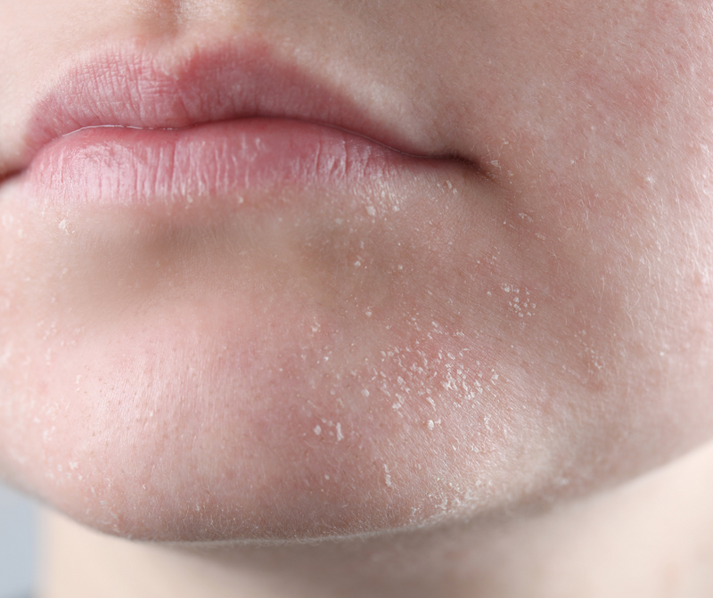 Diferencia entre piel seca y deshidratada: consejos para una piel radiante