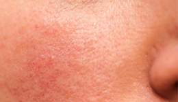 Rojeces en la cara: cómo calmar tu piel y recuperar su equilibrio natural