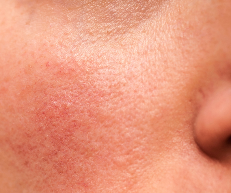 Rojeces en la cara: cómo calmar tu piel y recuperar su equilibrio natural